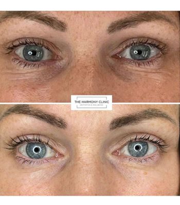 light-eyes-treatment-bedford-7