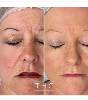 micro-needling-bedford-1