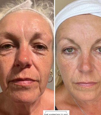 micro-needling-bedford-10