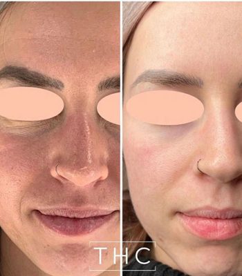 micro-needling-bedford-11