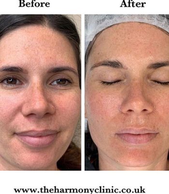 micro-needling-bedford-12