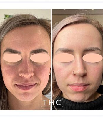 micro-needling-bedford-2