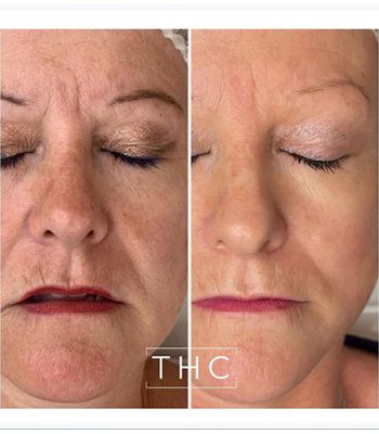 micro-needling-bedford-3