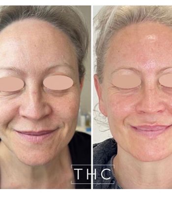 micro-needling-bedford-4