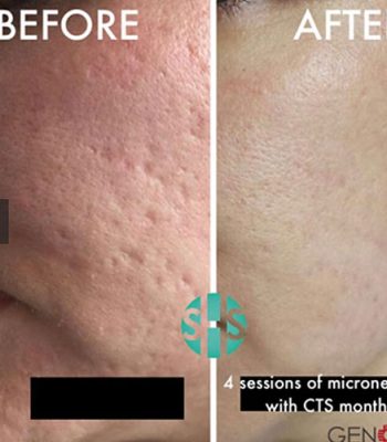 micro-needling-bedford-5