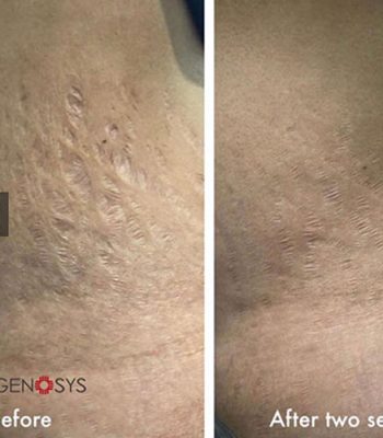 micro-needling-bedford-8