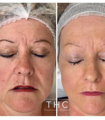 micro-needling-bedford-9