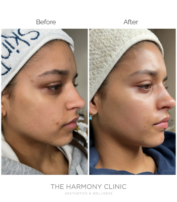 skinpen microneedling 2