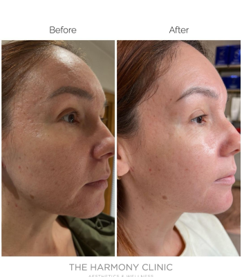 skinpen microneedling 3
